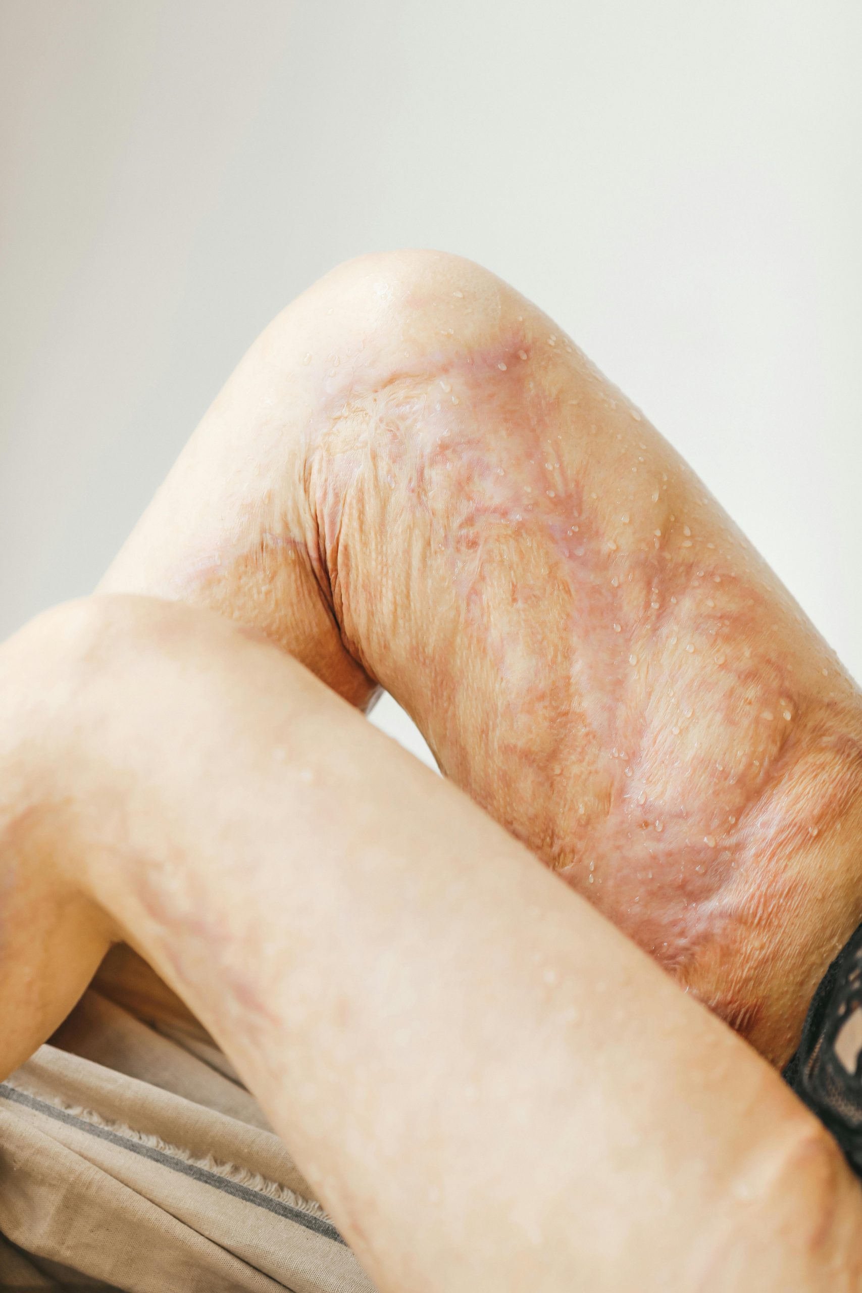 Étapes essentielles de la cicatrisation du microshading